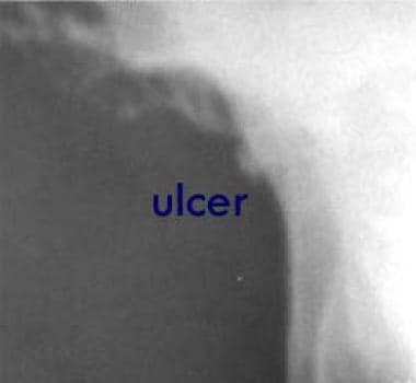 This image shows a small lesser-curve gastric ulce