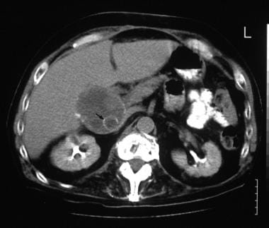 A transaxial enhanced CT scan in a 60-year old man
