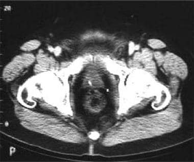 CT scan for low rectal carcinoma preoperative stag
