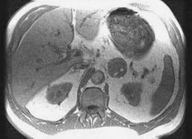 A 70-year-old asymptomatic man with a left adrenal