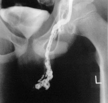 Left testicular venogram. This image shows a left 