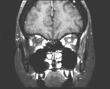 A 43-year-old woman with acute vision loss and eye
