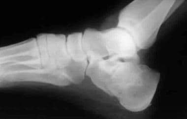 Calcaneus, fractures. Rowe type IV calcaneal fract