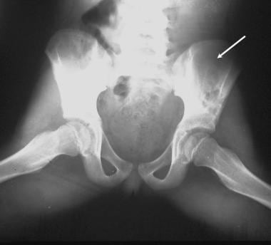 Plain radiograph of the pelvis in a 10-year-old gi