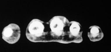 Axial CT scan shows a small radiopaque foreign bod