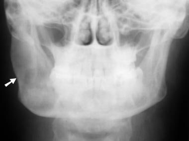 Frontal radiograph of the mandible in an adult wit