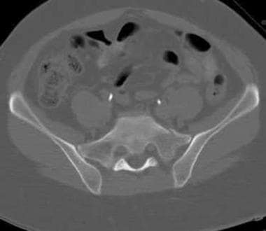 Lateral compression injury as seen on a pelvic CT 