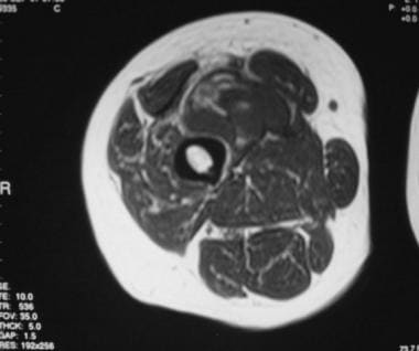 Firm lesion on the lateral thigh  Cleveland Clinic Journal of Medicine