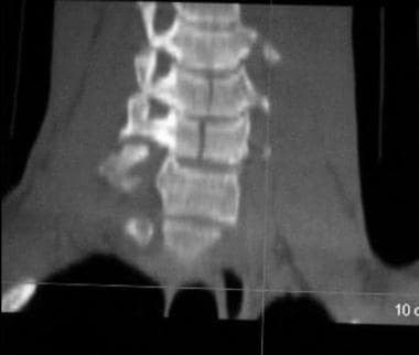 Oblique coronal reconstructions of cervical spine 