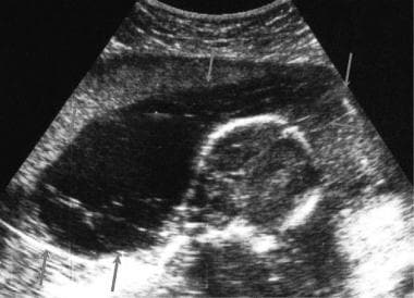 Longitudinal ultrasonogram through the fetal head 
