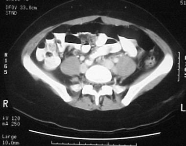 Subsequent contrast-enhanced computed tomography s