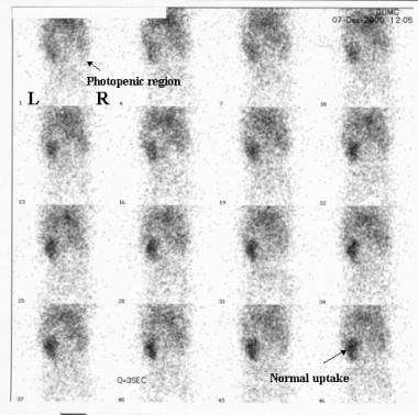 Initial perfusion images from a nuclear renal scan