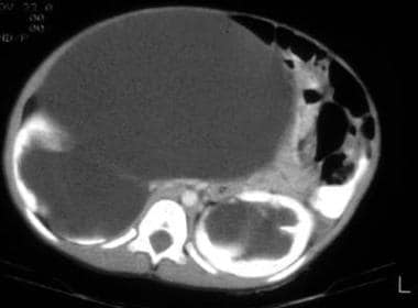 On CT, the ureter in this patient with prune belly