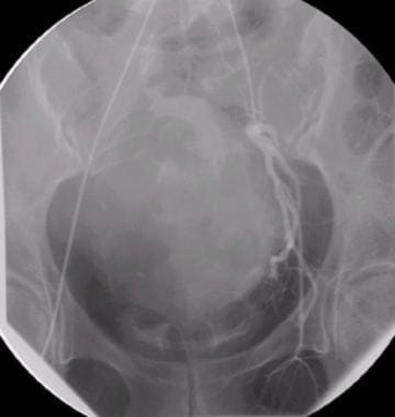 Uterine artery angiography (postembolization). 
