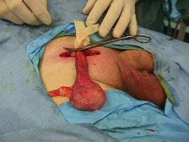 Right radical orchiectomy. Note the inguinal appro