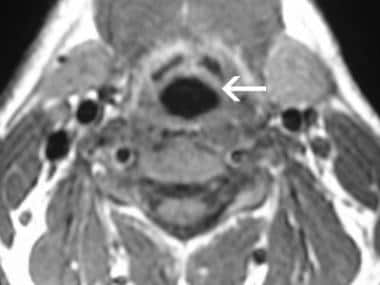 MR imaging, larynx. Image 3 of 3. T1-weighted axia