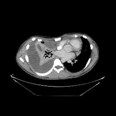 Axial CT image of a 19-year-old adolescent with Lu