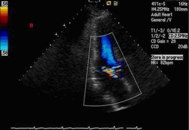 Echocardiography. This color Doppler image across 