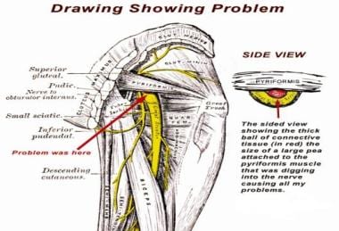 Superior Gluteal Nerve Injection