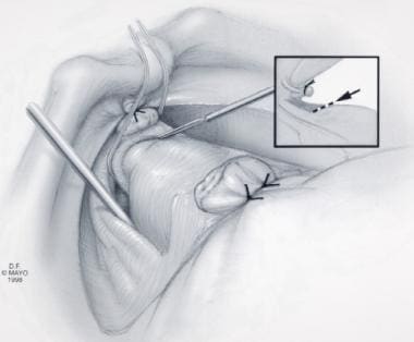 radical retropubic prostatectomy)