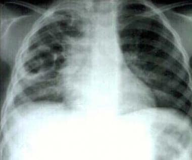 Pneumonia with multiple pneumatoceles. 