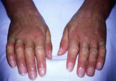 systemic scleroderma hands