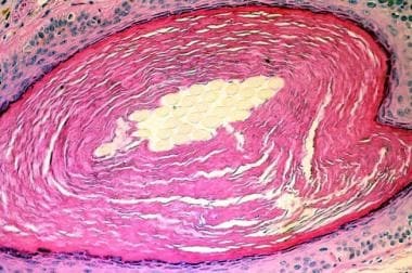 Biopsy specimen demonstrates a dilated follicle th