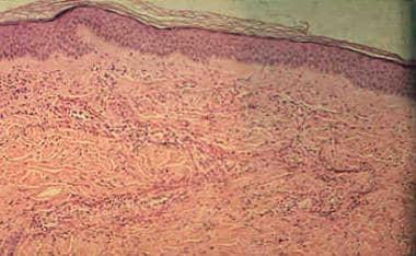 A low-power histologic image of urticarial vasculi