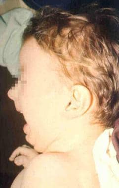 Rubinstein-Taybi syndrome-showing distinctive clinical features