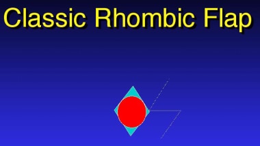 Classic rhombic flap. 