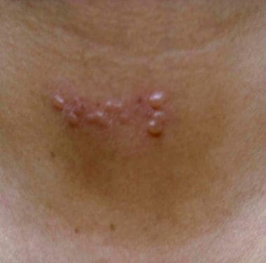 Herpes zoster on neck. 