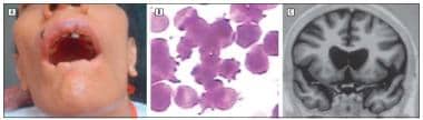 Patient with choreoacanthocytosis. A: Note self-mu