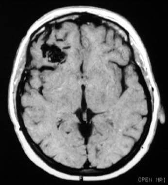 T1 axial MRI showing a small subcortical arteriove