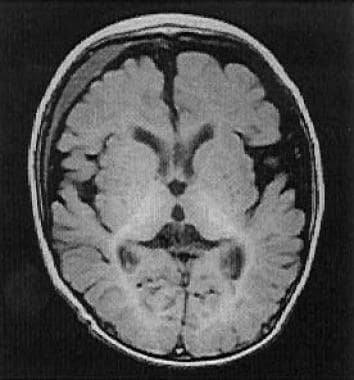 Magnetic resonance imaging of the brain of a patie