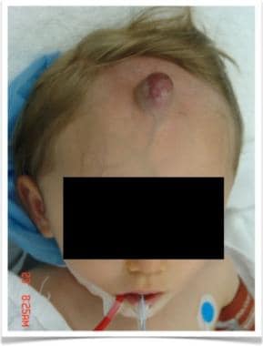Preoperative image of 1-year-old boy with forehead