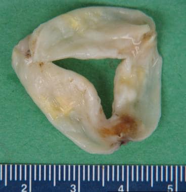 Aortic Stenosis Pathology. Rheumatic aortic stenos