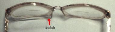 Glasses with a crutch attached (arrow) that can be