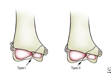 lateral condyle fracture milch