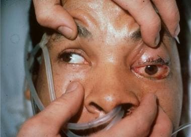 Upon looking to the right, the patient's left eye 