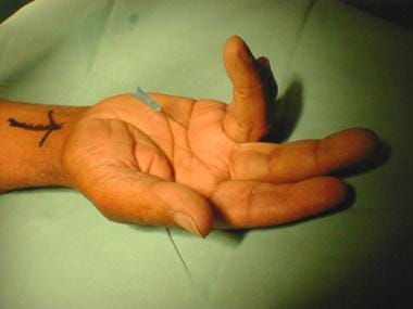 Movement of needle with flexion of digit confirms 