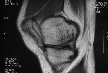 Osteochondritis dissecans. Postoperative MRI sagit