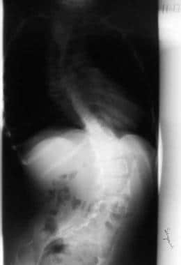 Spinal muscle atrophy. Spine anteroposterior view.