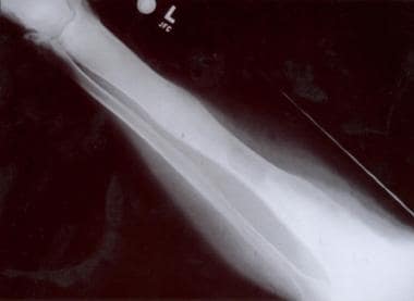 Fibrous dysplasia of a long bone characterized by 