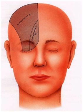 Direct brow lift. Innervation by the supraorbital 