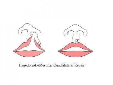 Hagedorn-LeMesurier repair. The medial lip element