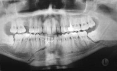 Left mandibular angle fracture involving tooth #17