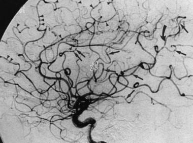 Lateral right internal carotid angiogram shows bea