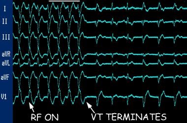 v fib contre v tach