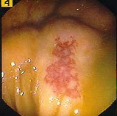 Angiodysplasia identified on the cecum wall during