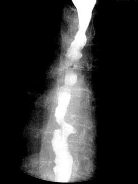 Barium swallow demonstrates diffuse uncoordinated 